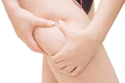 Cellulite Addressing the Basic Causes
