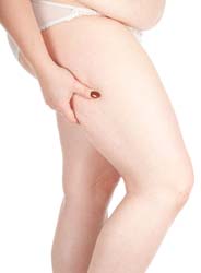 Cellulite Causes, Symptoms and Remedies Cellulite Causes, Symptoms and Remedies