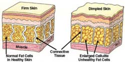 Discover the Cellulite Facts