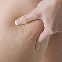 Discover the Cellulite Facts