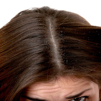 How to Deal with Dandruff