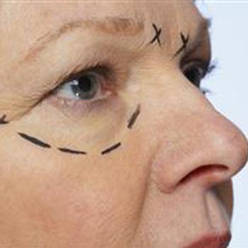 How to get rid of Bags under the Eyes