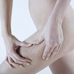 Factors That Lead To Cellulite Factors That Lead To Cellulite