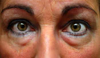 Cut Back your Dark Circles with Hydrolyze
