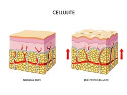 Treatment Of Cellulite Through Liposome Delivery Systems Treatment Of Cellulite Through Liposome Delivery Systems