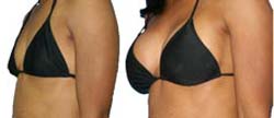 Perfect Curves Before and After Pictures
