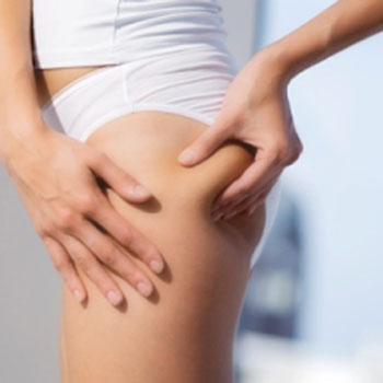 Preventing Cellulite