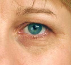 Causes of Dark Circles - Dark Circles Under Eyes