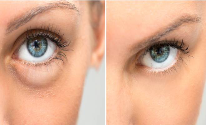 Eye Bags Removal Cream