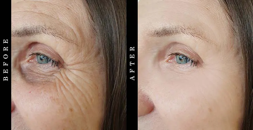 best-anti-aging-serum-before-after