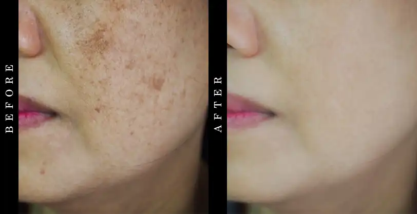 best-dark-spot-corrector-before-after
