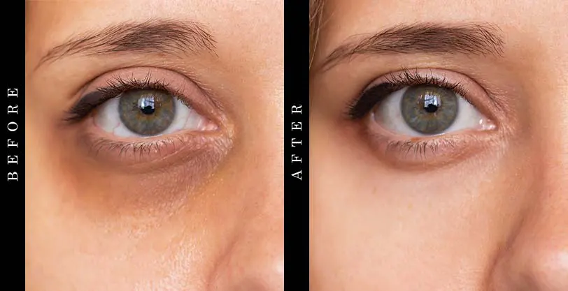 Best Eye Creams - Before and After