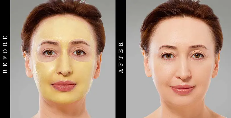 best-face-masks-before-after