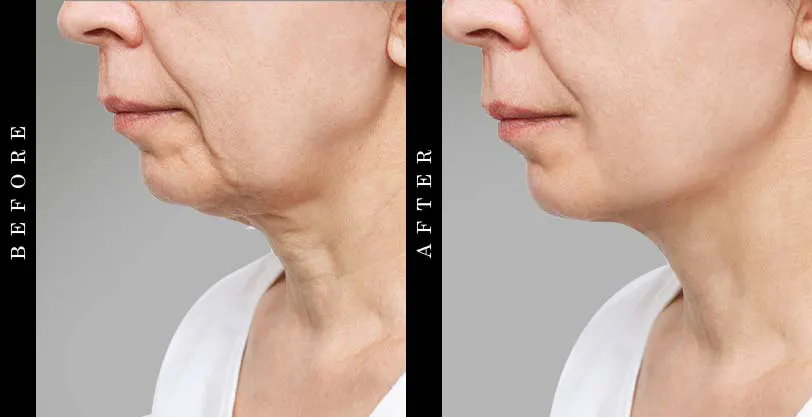 best-neck-creams-before-after