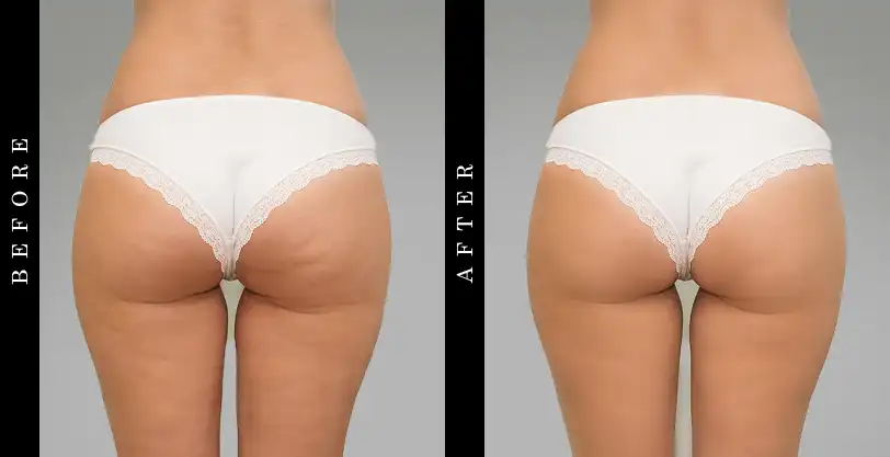 Best Cellulite Creams Before & After Image