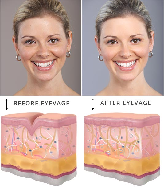 eyevge before and after