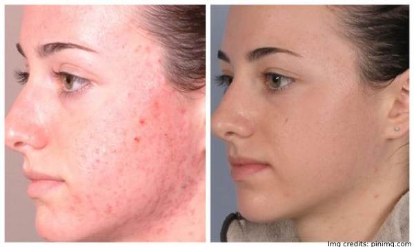 Is Microdermabrasion Good For Acne Scars On Your Face Is Microdermabrasion Good For Acne Scars On Your Face