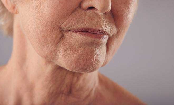 Perioral Wrinkles