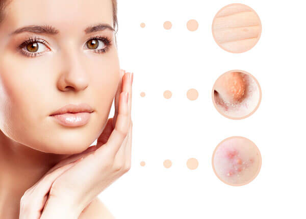 Scar Surgery To Treat Depressed Acne Scars