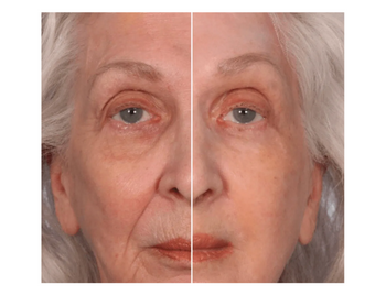 Serious Skin care Insta Tox Before and After