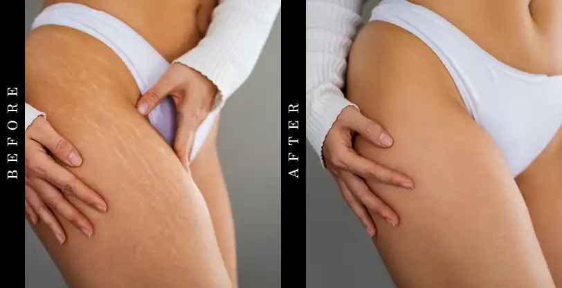 stretch-marks-before-after