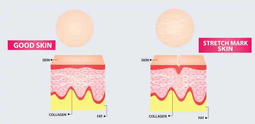 stretch-skin-mark