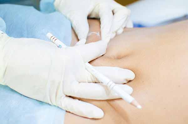 Subcision For Cellulite