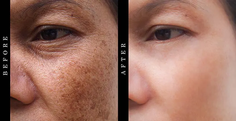 sunscreen-before-and-after-image