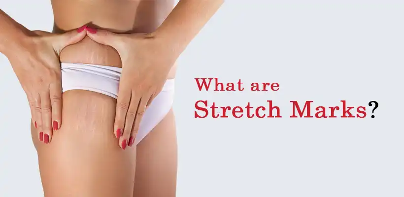 what-are-stretch-marks