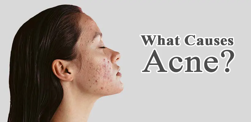 what-causes-acne