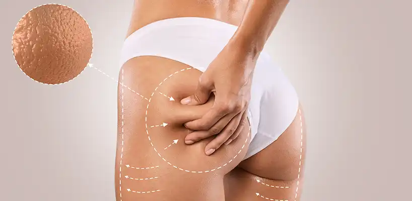 How to Choose Best Cellulite Creams
